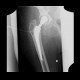 Hip replacement, cemented, leak of cement into the pelvis: X-ray - Plain radiograph